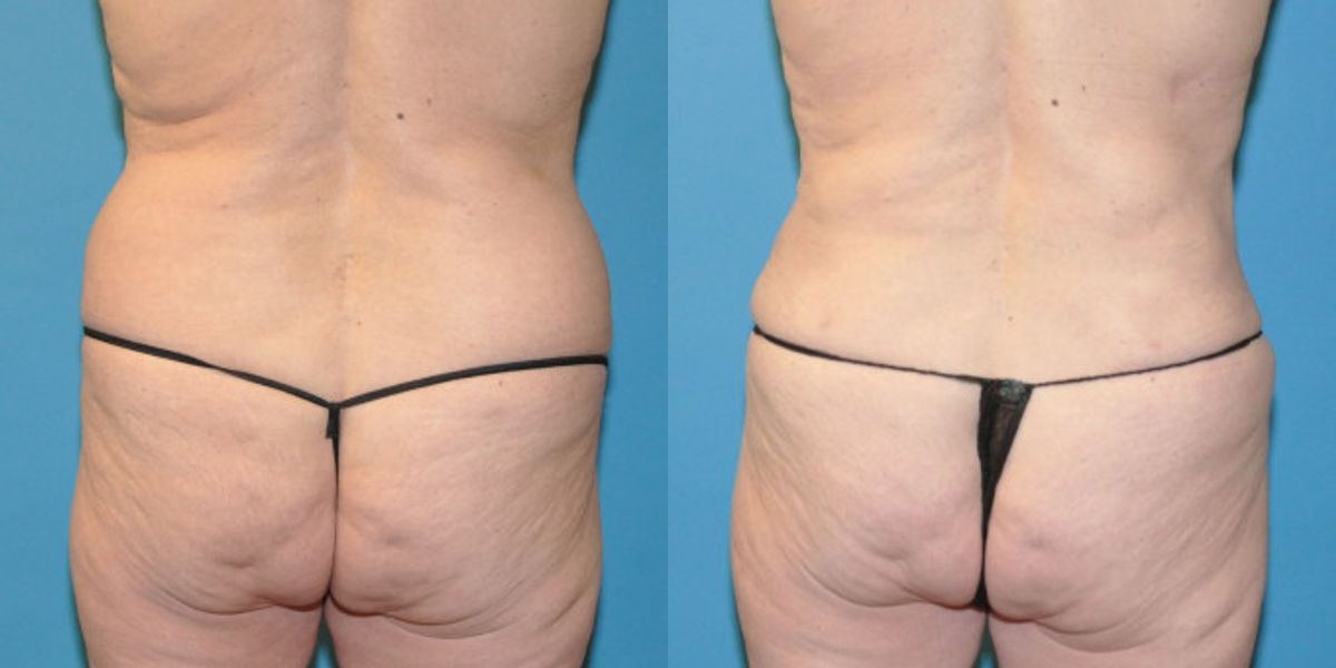 Liposuction #6 - Before and After