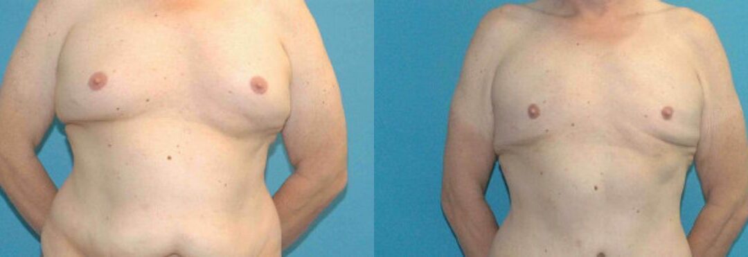 Liposuction #8