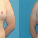 Liposuction #8 - Before and After