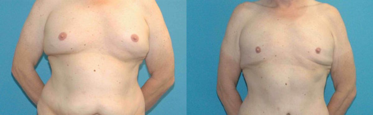 Liposuction #8 - Before and After