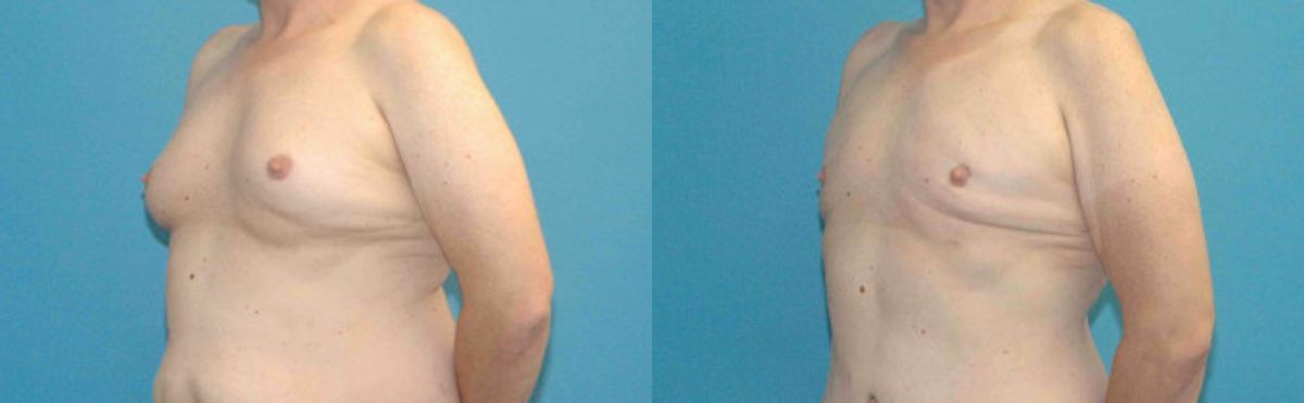 Liposuction #8 - Before and After