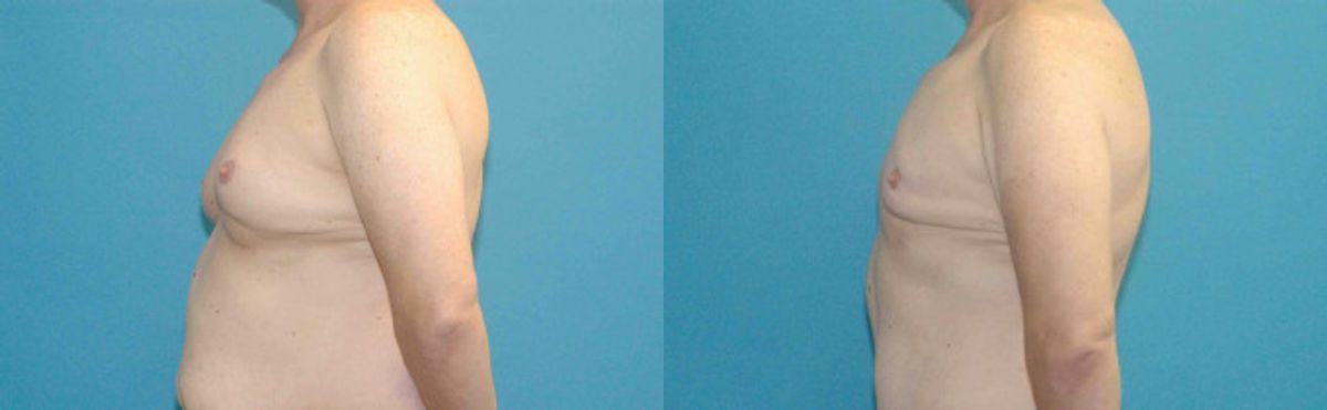 Liposuction #8 - Before and After