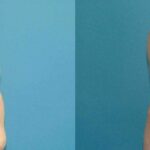 Liposuction #8 - Before and After