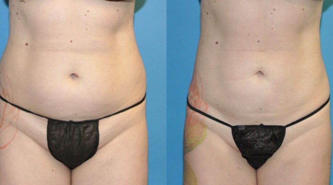 Liposuction #9