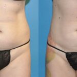 Liposuction #9 - Before and After