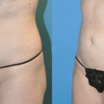 Liposuction #9 - Before and After