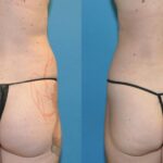 Liposuction #9 - Before and After