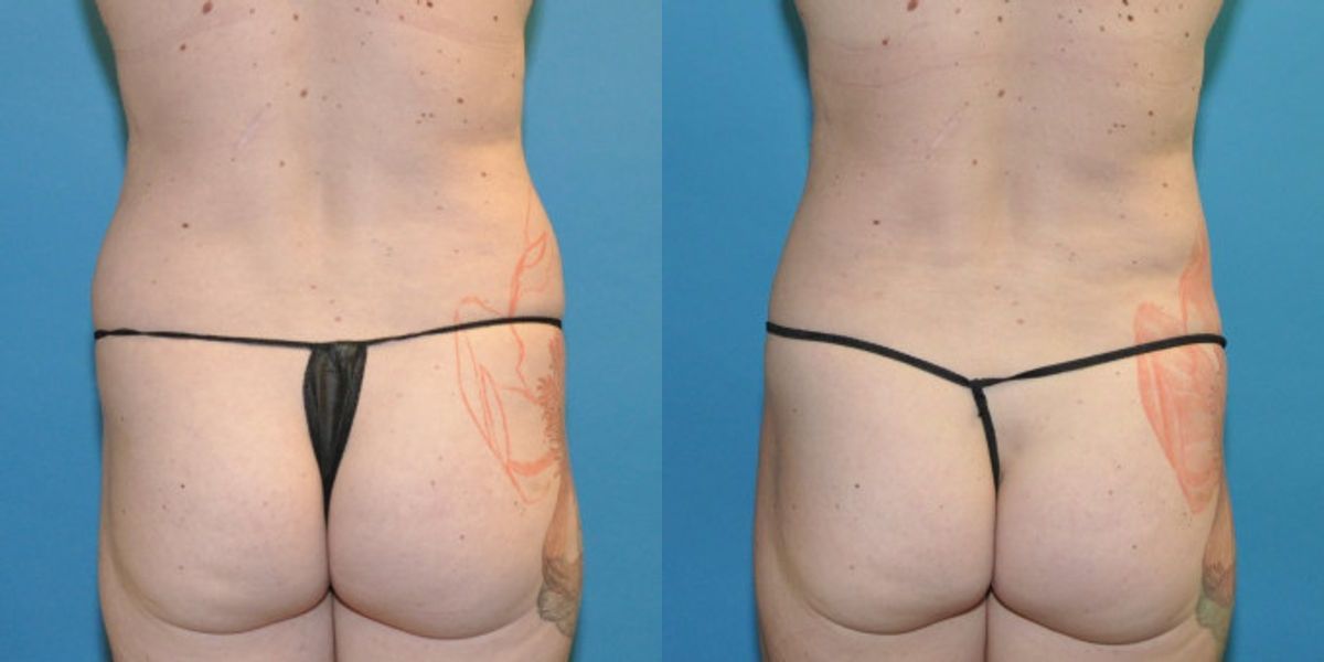 Liposuction #9 - Before and After