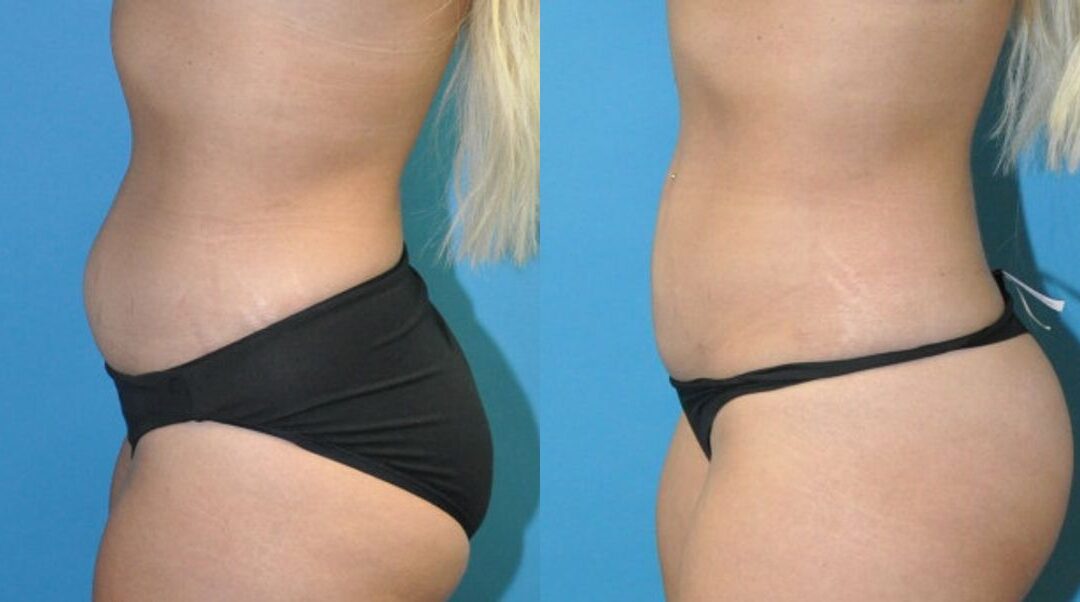 Liposuction #10
