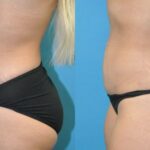 Liposuction #12 - Before and After