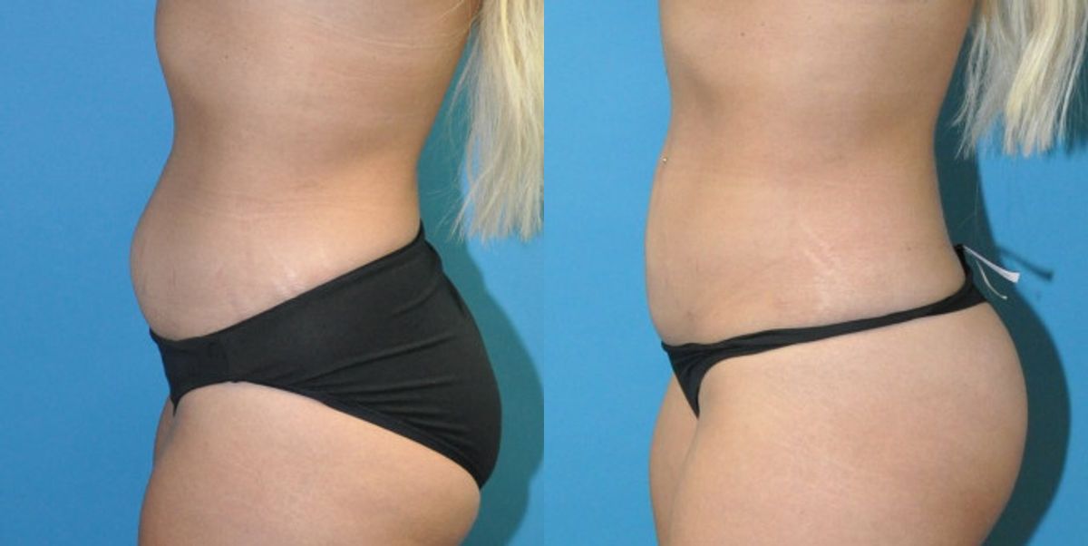 Liposuction #12 - Before and After