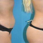 Liposuction #12 - Before and After
