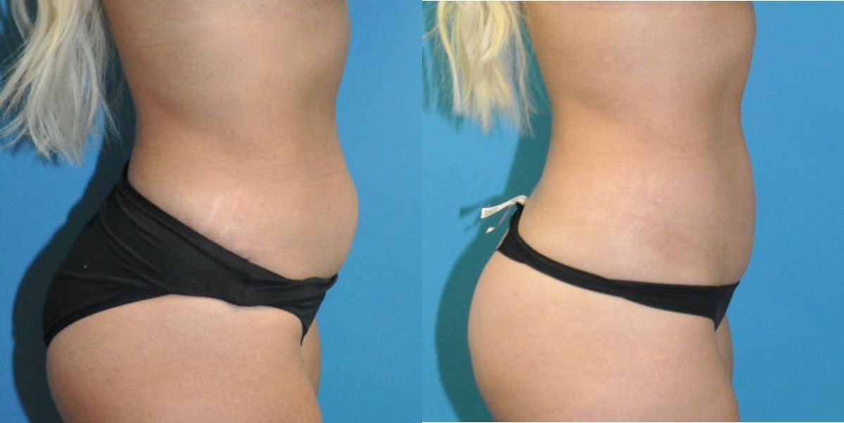 Liposuction #12 - Before and After