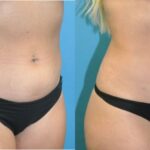 Liposuction #12 - Before and After