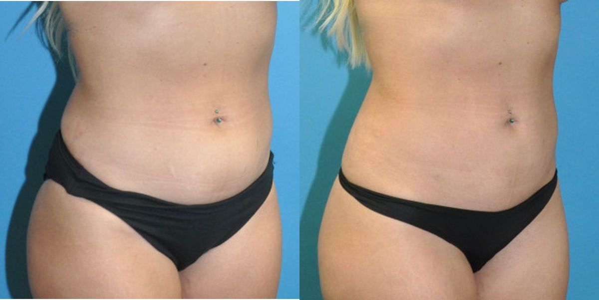 Liposuction #12 - Before and After