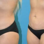Liposuction #12 - Before and After