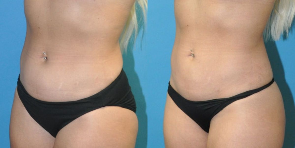 Liposuction #12 - Before and After