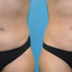 Liposuction #12 - Before and After