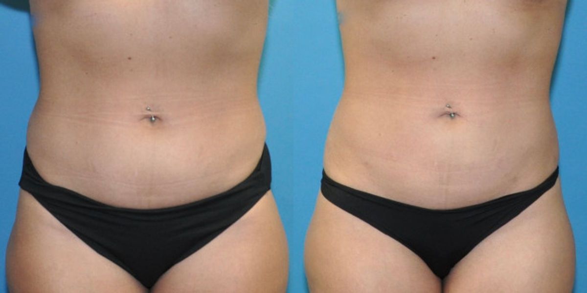 Liposuction #12 - Before and After