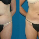 Liposuction #13 - Before and After