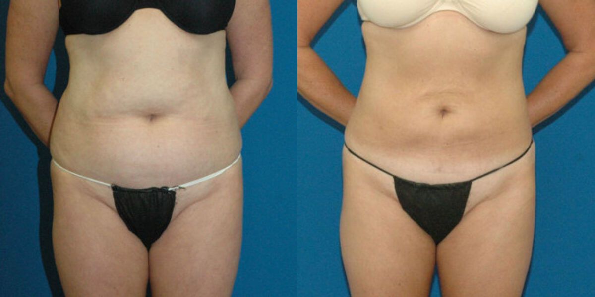 Liposuction #13 - Before and After