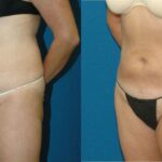Liposuction #13 - Before and After