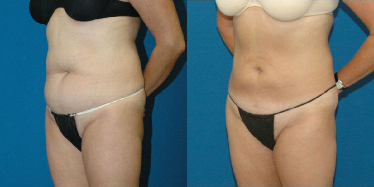 Liposuction #13 - Before and After