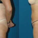 Liposuction #13 - Before and After