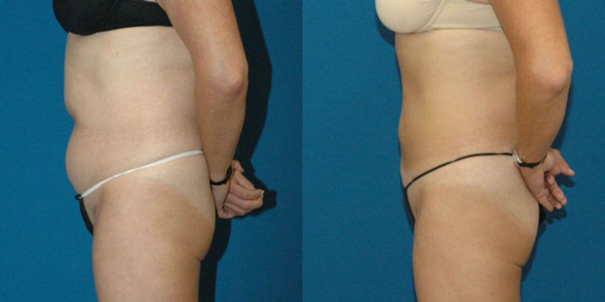 Liposuction #13 - Before and After