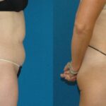 Liposuction #13 - Before and After