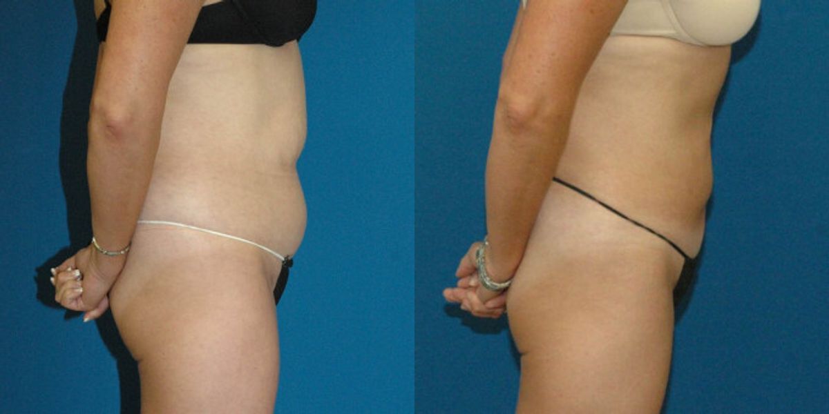 Liposuction #13 - Before and After