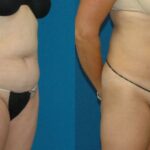 Liposuction #13 - Before and After
