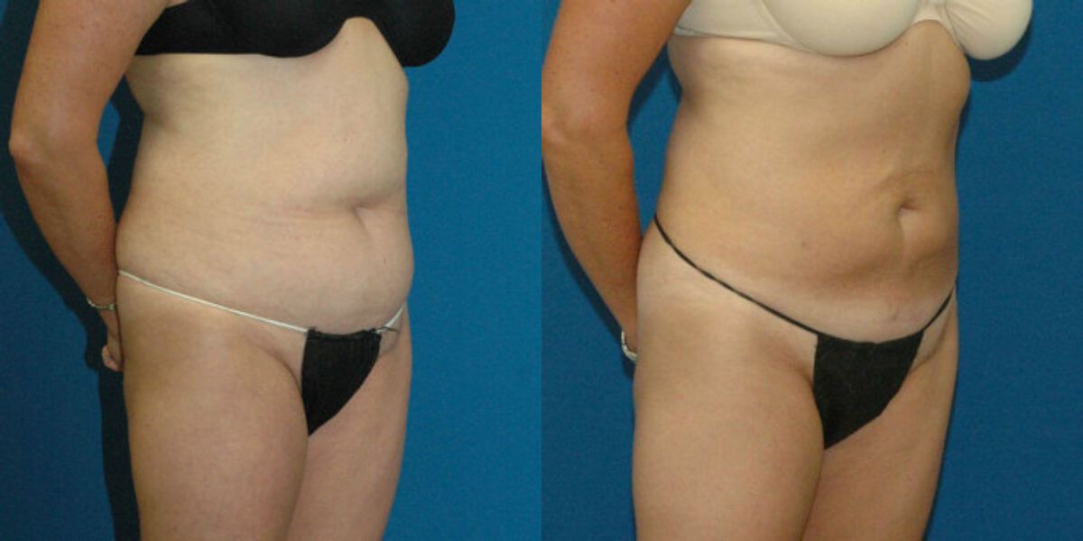 Liposuction #13 - Before and After