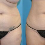 Liposuction #14 - Before and After
