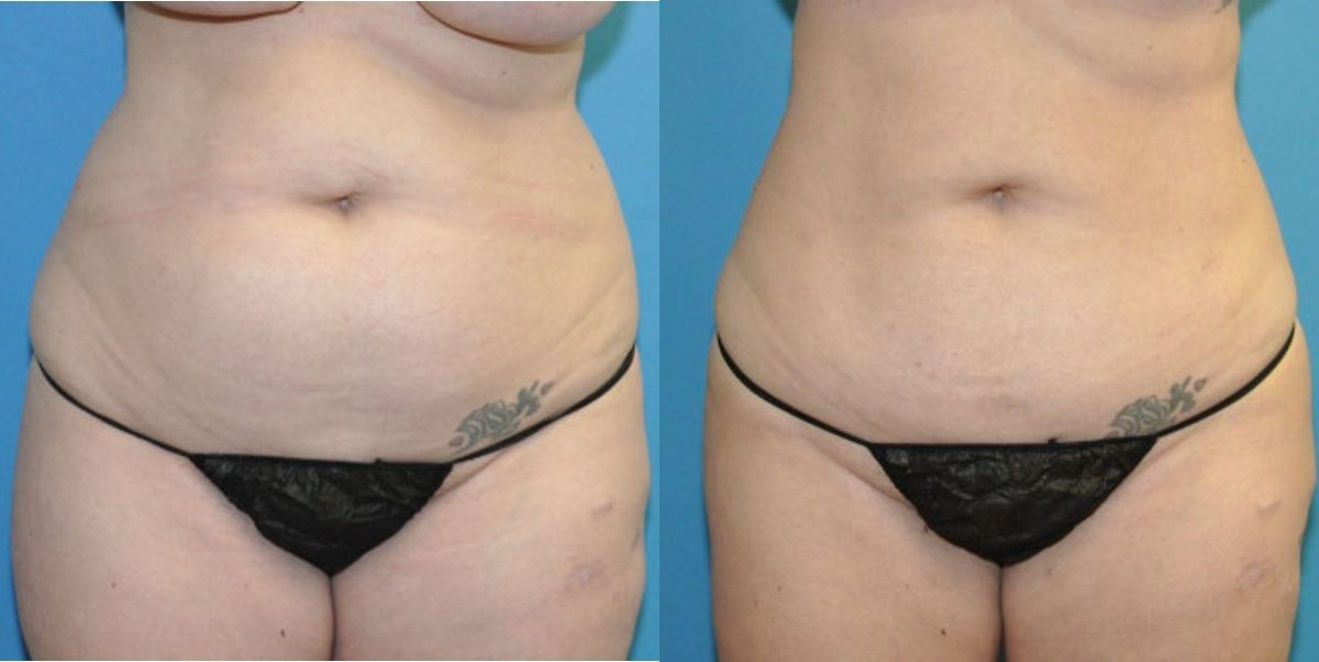 Liposuction #14 - Before and After