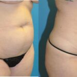 Liposuction #14 - Before and After