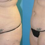Liposuction #14 - Before and After