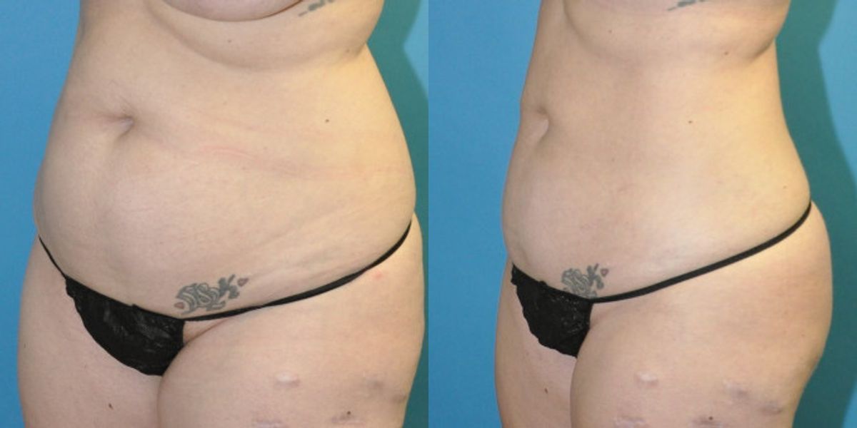 Liposuction #14 - Before and After