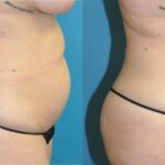 Liposuction #14 - Before and After