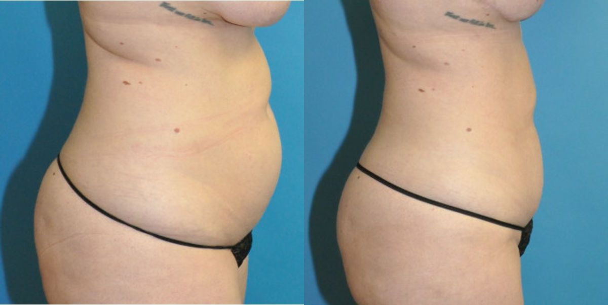 Liposuction #14 - Before and After