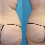 Liposuction #14 - Before and After