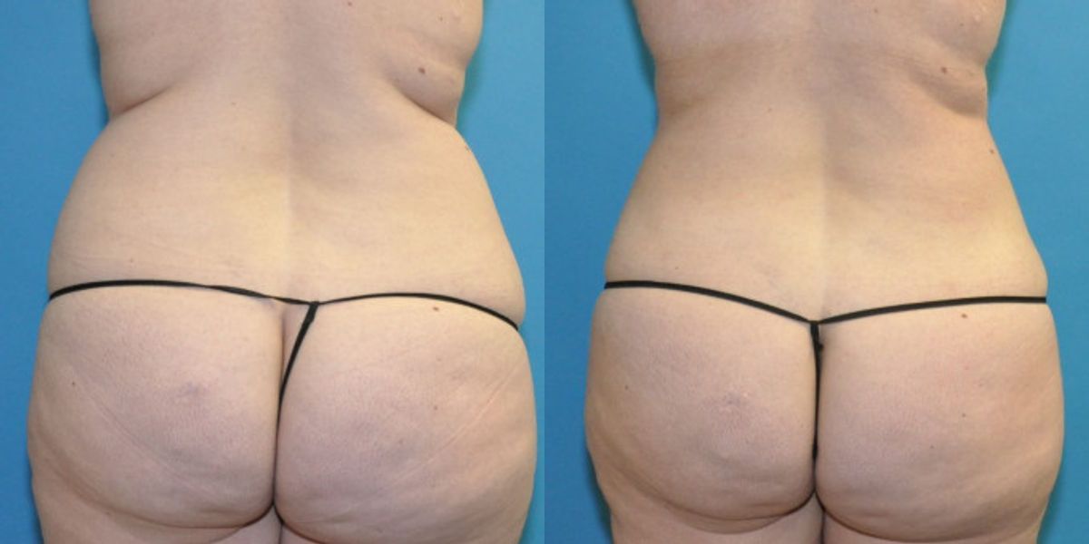 Liposuction #14 - Before and After
