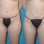 Liposuction #7 - Before and After