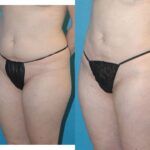 Liposuction #7 - Before and After