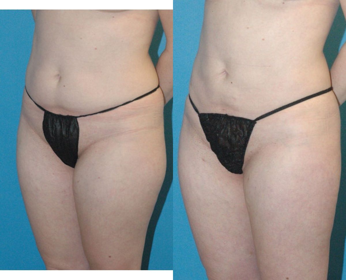 Liposuction #7 - Before and After