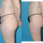 Liposuction #7 - Before and After