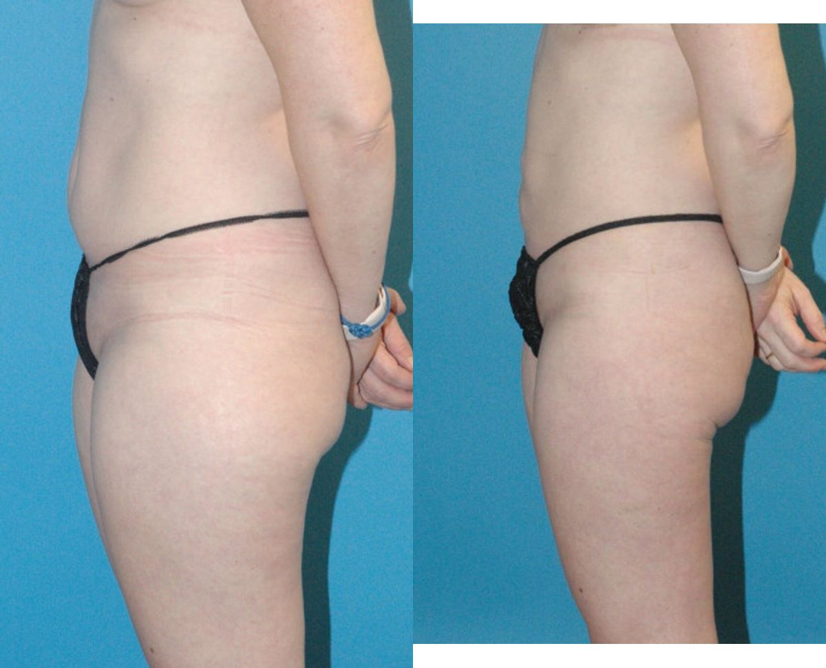 Liposuction #7 - Before and After