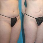 Liposuction #7 - Before and After