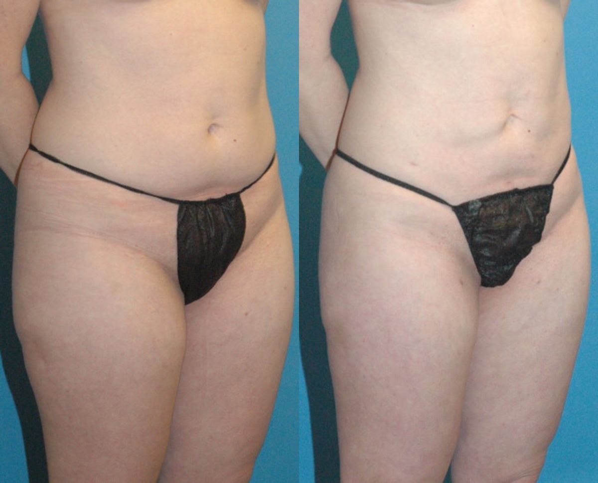 Liposuction #7 - Before and After
