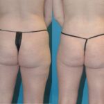 Liposuction #7 - Before and After